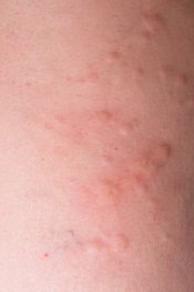 What Do Hives Look Like - What Causes Hives - Picture of Hives